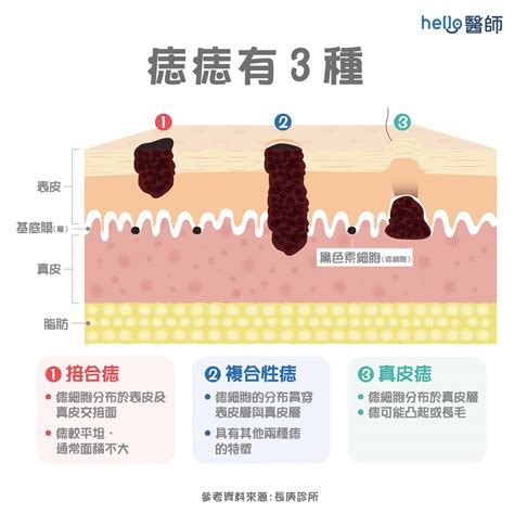 痣怎麼來的|痣變大、痣多或長毛會變皮膚癌？認識痣的形成與原因